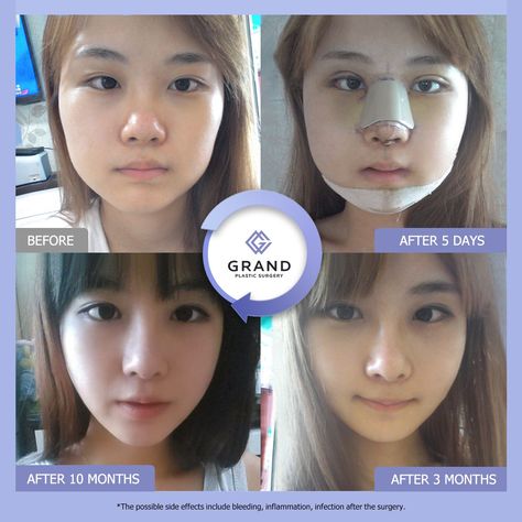 Korean Plastic Surgery Before And After, South Korean Plastic Surgery, V Line Surgery, Plastic Surgery Fail, V Line Face, Korean Plastic Surgery, V Shape Face, Plastic Surgery Photos, Botox Lips