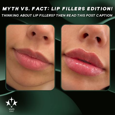 💋 Thinking about lip fillers? Let’s set the record straight with some Myths vs. Facts! 💉✨ 🚫 Myth: Lip fillers will make my lips look unnatural. ✅ Fact: At Vivid Clinic, our skilled experts provide tailored results that enhance your natural beauty. 🚫 Myth: Lip fillers are permanent. ✅ Fact: Lip fillers typically last 6-12 months and can be adjusted to your preference. 🚫 Myth: Lip fillers are painful. ✅ Fact: Our procedures include numbing agents, so discomfort is minimal. 💬 Ready to enhanc... Myths Vs Facts, Beauty Myth, Lip Fillers, 12 Months, Natural Beauty, Lips, Let It Be, Beauty, Quick Saves