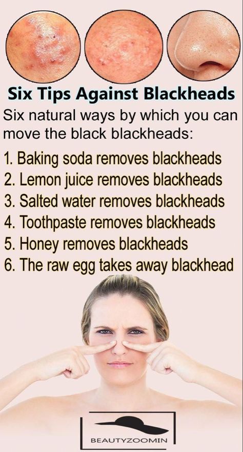 How To Remove Blackheads, To Remove Blackheads, Remove Blackheads, Natural Sleep Remedies, Clear Skin Tips, Baking Soda Shampoo, Get Rid Of Blackheads, Natural Cough Remedies, Skin Care Remedies