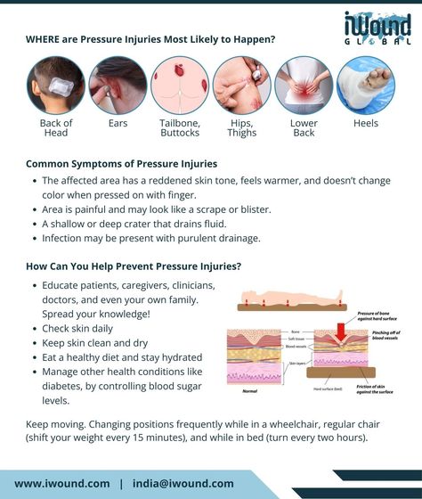 Understanding Pressure Injuries Pressure injuries, commonly known as pressure ulcers or bedsores, are localized damage to the skin and underlying tissue caused by prolonged pressure. Here are some essential facts: 1️⃣ At-Risk Populations: Individuals with limited mobility, such as the elderly, those with spinal cord injuries, or patients in long-term care settings, are particularly at risk. 2️⃣ Stages of Pressure Injuries: These injuries are classified into four stages, ranging from stage ... Pressure Ulcer Staging, Pressure Injury, Spinal Cord Injuries, Pressure Ulcer, Can You Help, Spinal Cord, Long Term Care, Caregiver, Staging