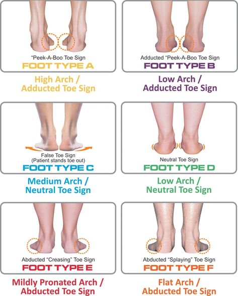 Understanding Foot Types and Managing the Adolescent Athlete Athlete Exercises, Patellofemoral Pain Syndrome, Bursitis Hip, Foot Anatomy, Foot Exercises, Athletes Foot, Hip Pain, Foot Health, Anatomy And Physiology