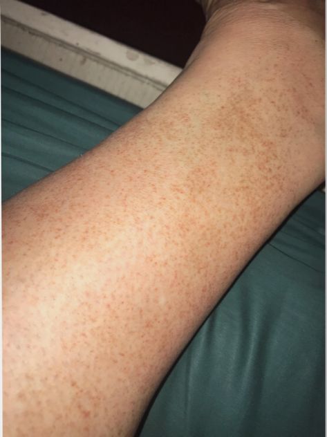 Leg Freckles, Skin Concern, Red Dots, Coming Out, Dots, Skin, Health, Red, Beauty