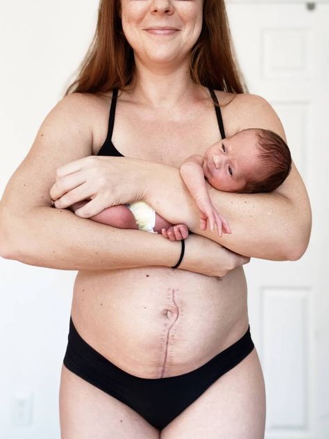 A MUM who had 40 staples in her stomach after an emergency C-section birth has proudly shared pictures of her unusual vertical scar on social media. Erin Bahadur, 36, from North Carolina, gave birth to her second child, daughter Remy, in December 2020. The mum suffered from a complete placenta previa – when the baby’s […] C Section Scar, Wedding Bodysuit, Emergency C Section, C Section Scars, Cesarean Section, First Person Writing, C Section, Fresh Face, Second Child