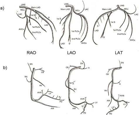 Coronary arteries Cath Lab Nursing, Cath Lab Nurse, Coronary Circulation, Heart Catheterization, Cardiac Anatomy, Arteries Anatomy, Cardiac Sonography, Cardiology Nursing, Interventional Cardiology