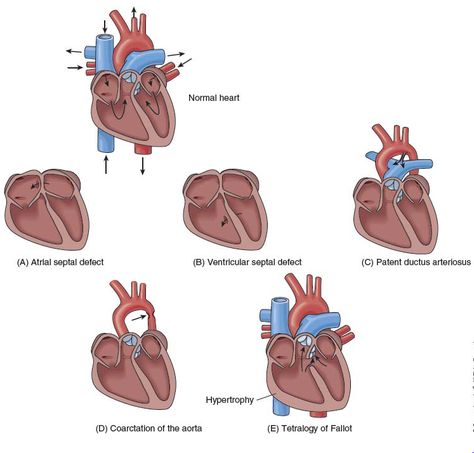 Clinical Anatomy, Unwanted Hair Growth, Congenital Heart Defect, Heart Anatomy, Heart Defect, Congenital Heart, Medical School Essentials, Coronary Arteries, Diy Hair Care