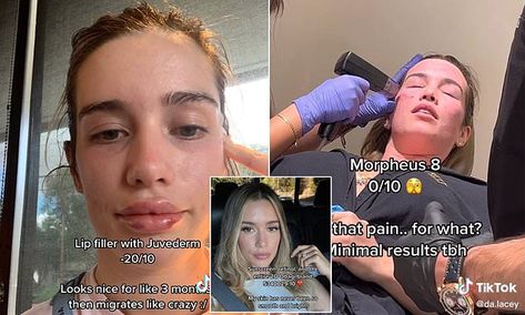 I work in the cosmetics industry, here are the procedures you should never get | Daily Mail Online Prp Face Before And After, Facetite Procedure, Esthetic Procedures, Cosmetic Procedures For Face, Skincare Procedure, Benefits Of Facial Extractions, Hygiene Ideas, Facial Reconstruction Surgery, Morpheus 8