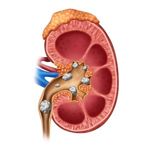 Illustration of a human kidney with several kidney stones blocking the urinary tract. Renal Calculi, Gallbladder Stones, Acute Kidney Injury, Kidney Stone, Uric Acid, Kidney Health, Digestion Problems, Homeopathy, Disease