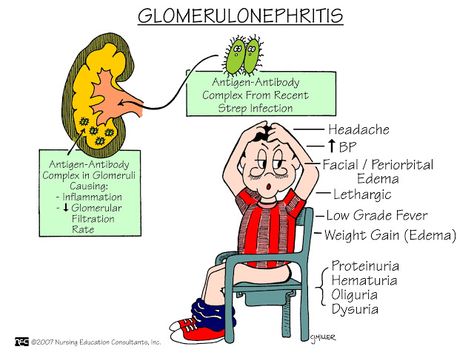 Nursing Mnemonics and Tips: Glomerulonephritis plus more... Nephrotic Syndrome, Nursing Information, Nursing Board, Med Surg Nursing, Nursing Study Guide, Nursing Mnemonics, Surgical Nursing, Medical Surgical Nursing, Nursing School Survival