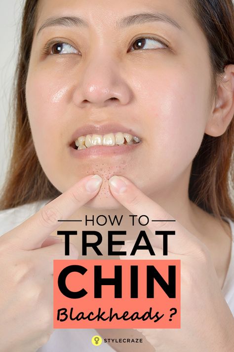 How To Treat Chin Blackheads? Rid Of Blackheads, Winter Skincare, Skincare Secrets, Natural Hair Mask, Types Of Acne, Get Rid Of Blackheads, Natural Health Tips, Lose 40 Pounds, Beauty Tutorials