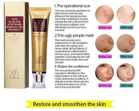 Acne Scar Remover Cream – Verdeshop100 Acne Mark Removal, Acne Scar Removal Cream, Scar Removal Cream, Pimple Scars, Coconut Oil For Acne, Scar Cream, Bleaching Cream, Acne Scar, Acne Scar Removal