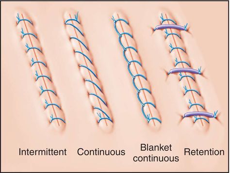 http://medical-dictionary.thefreedictionary.com/_/viewer.aspx?path=MosbyMD types of stiches Vet Tech Tattoo, Stitches Medical, Surgical Technologist Student, Surg Tech, Surgical Technician, Medical Dictionary, Surgical Suture, Surgical Technologist, Vet Medicine