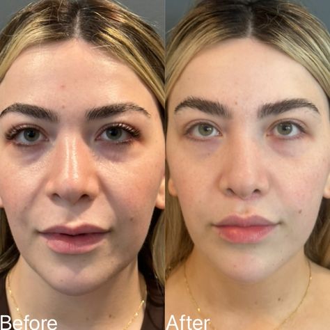 I had the absolute pleasure of seeing this beautiful bride-to-be for her 2 month follow-up. 👰‍♀️ We did a subtle upper lip lift to balance out her facial features and reveal more of her natural volume. The scar is a little pink as expected in this stage of healing, and will keep improving over the next few months. We are so excited for her next big chapter! #liplift #subnasalliplift #upperliplift Upper Lip Lift, Lip Lift, Upper Lip, Facial Features, Beautiful Bride, So Excited, Facial, The Next, Lips