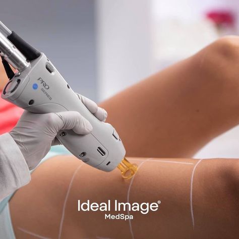 Body Laser Photography, Laser Depilation, Laser Hair Removal Candela, Leg Hair Removal, Silky Legs, Low Level Laser Therapy, Laser & Ipl Hair Removal Devices, Laser Clinics, Hair Reduction