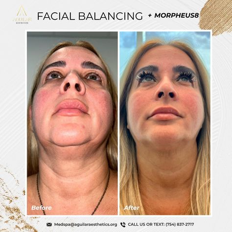 ✨ Facial Balance & Harmonization with Morpheus8 Technology ✨ Achieve rejuvenated skin and a balanced look with our combination of facial harmonization techniques and advanced Morpheus8 technology! Through a personalized approach, we redefine and sculpt facial contours, soften fine lines, improve skin texture, and create a refreshed, natural appearance. 💫 ✨ Aguilar Aesthetics & MedSpa 📲754-837-2717 💠www.aguilaraesthetics.com 🏢 ✨ Aguilar Aesthetics & MedSpa 📍 2820 NE 214th Street, Suite 844... Improve Skin Texture, Med Spa, Skin Texture, Improve Skin, Facial, Technology, Texture, Skin, Quick Saves