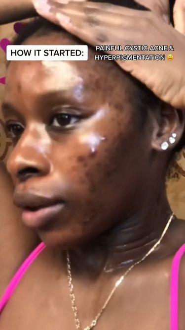 How to clear Acne Hyperpigmentation Completely Face Map, Back Acne Remedies, Oily Acne Prone Skin, Acne Hyperpigmentation, Facial Scars, Forehead Acne, Allies Of Skin, Acne Face, Acne Treatments