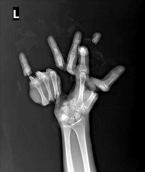 Medicalpedia on Instagram: “⚠️ Trauma caused by an agricultural machine, severing the hand in multiple locations. The patient underwent reconstructive surgery lasting…” Ap Drawing, Medical Pictures, Blood Donor, Famous Monsters, Reconstructive Surgery, X Rays, Emergency Medicine, Free Medical, Spiritual Meaning