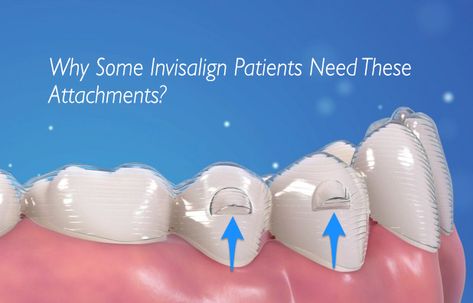 Cleaning Invisalign Trays, Invisalign Tips And Tricks, Invisalign Before And After, Invisalign Aesthetic, Invisalign Attachments, Invisalign Hacks, Permanent Retainer, Invisalign Aligners, Dental Bonding