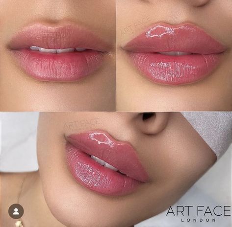 Lip Fillers Heart Shape, Lips Fillers Shapes, Lip Filler Inspiration 1ml, Hyaluronic Lips, Lip Filler Shapes, Russian Lips Filler, Lip Filler Shape Ideas, Lip Filler Aesthetic, Desired Lips