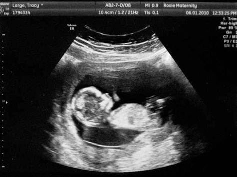 The 12-week scan, when you see your real, actual child for the first time is the most awe-inspiring thing you'll witness. | The 19 Stages Of Pregnancy From A Man's Perspective 12 Week Ultrasound Pictures, 12 Weeks Pregnant Ultrasound, Ultrasound Pictures Gender, Boy Ultrasound Pictures, Boy Ultrasound, Fake Ultrasound, 12 Week Ultrasound, 12 Week Scan, Baby Ultrasound Pictures