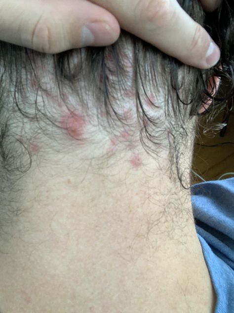 Whats the deal with back of neck hairline pimples? What could cause them? How do I get rid of them? More in comments...- ThorGift.com - If you like it please buy some from ThorGift.com Back Of Neck Hairline, Neck Hairline, Neck Pimples, Clear Skin Routine, Pimples Remedies, Back Of Neck Tattoo, Men's Hairstyle, Face Care Routine, Clear Skin Tips