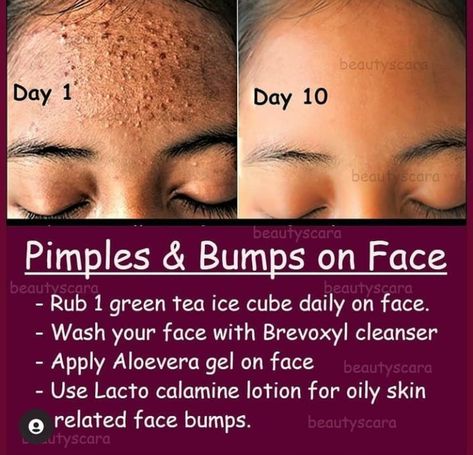 Small Pimples On Face, Bumps On Face, Small Bumps On Face, Face Skin Care Products, Mom Self Care, Beginner Skin Care Routine, Blind Pimple, Get Rid Of Pimples, Rid Of Pimples