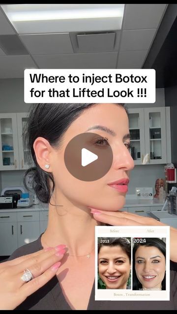 Enki Nichols | Lone Tree Aesthetics Med Spa on Instagram: "The number of Botox units needed varies from person to person and depends on several factors, including: Facial structure, Facial muscle strength and size, Desired outcome, Severity of wrinkles, Age, Gender, Skin condition, Previous Botox experience, Metabolism A qualified injector can help you determine the appropriate dosage and achieve the look you want. #botox #hoodedeyes #openeyes #browlift #eyelift #lipflip #dao #jowls #noselift #nosetox #nurseinjector #beforeandafter #educational #denvercolorado #lonetreecolorado" Botox Before And After Eyes, Botox Face Lift Before And After, Botox Eye Lift Before And After, Places To Get Botox On Face, Botox For Frown Lines, Preventative Botox Before And After, Botox On Jawline, Botox Nose Job, Botox Locations On Face