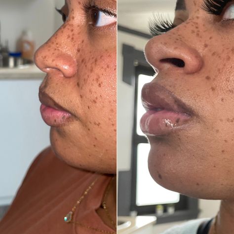 Lip Injections Black Women, Needle Less Lip Filler, Lip Injections Before And After Black Women, Lip Fillers On Black Women, Lip Filler Before And After Black Women, Lip Filler Black Women, Needless Lip Filler, Lip Filler Before And After, Juvederm Lips