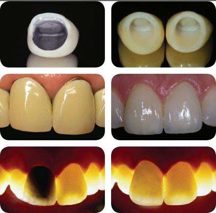 Zirconia dental crowns are computer designed and are all porcelain which is very cost-effective. A lot of patients choose zirconia crowns for many reasons. Most dentists now recommend zirconia crowns and we will discuss why. Many patients want to know is this type of dental crown contains metals or causes allergic reactions and in terms of aesthetics is it worth choosing over other types of dental crowns. Zirconia Crowns Teeth, Dental Pictures, Porcelain Crowns, Tooth Crown, Tooth Care, Dental Posters, Dental Restoration, Dentist Clinic, Loose Tooth