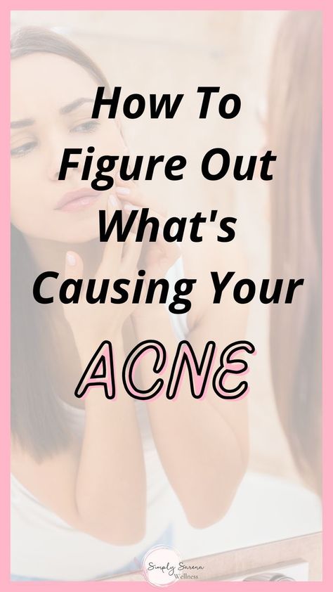 How To Figure Out What's Causing Your Acne Where Acne Is And What It Means, T Zone Acne, Teenage Acne Skincare Routine, Bacterial Acne, Teen Facial, What Causes Acne, Nodular Acne, Back Acne Remedies, Cystic Acne Remedies