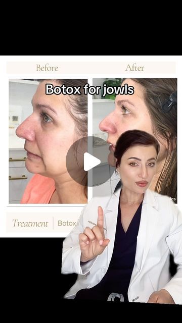 Enki Nichols | Lone Tree Aesthetics Med Spa on Instagram: "Botox can reduce sagging jowls by tightening and lifting the jaw area. I was so impressed with her results #dao #jowls #botox #nurseinjector #denvercolorado #results #beforeandafter #love" Dao Botox Before After, Neck Botox Before And After, Botox For Jowls, Jaw Botox Before After, Jaw Filler Before And After, Botox Placement, Botox Jawline Before And After, Botox Before After, Jowls Sagging