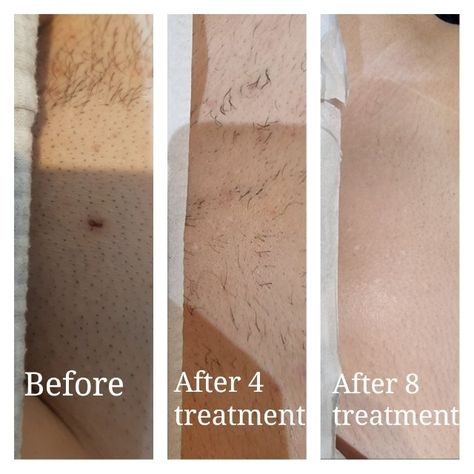 Before and after laser hair removal to the bikini line in a cosmetic clinic in Risca, South Wales Painless Waxing, Easy Hair Removal, Laser & Ipl Hair Removal Devices, Cosmetic Clinic, Painless Hair Removal, Botox Fillers, Ipl Hair Removal, Body Hair Removal, Unwanted Hair Removal