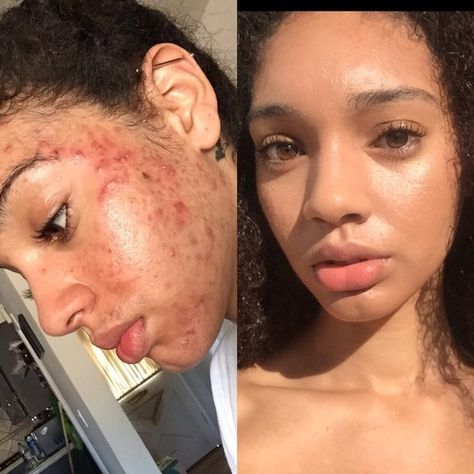 This All-Natural Acne Skin-Care Routine Is Going Viral on Instagram | Allure Acne Skincare Routine, Natural Acne, Going Viral, Skin Complexion, Acne Skin, Skin Care Acne, Skin Care Women, Better Skin, Beauty Secrets