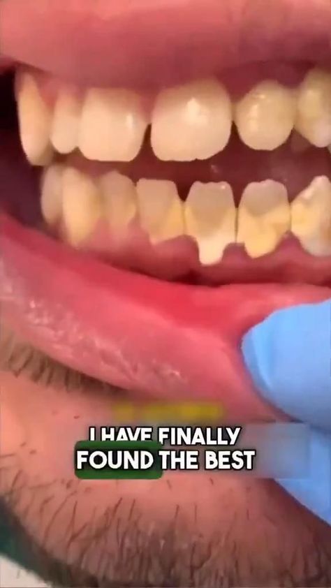 Salt Toothpaste, Natural Teeth Whitening Diy, Home Teeth Whitening, Teeth Whitening Homemade, Whitening Teeth, Teeth Whitening Diy, Face Skin Care Routine, Diy Skin Care Routine, Teeth Health