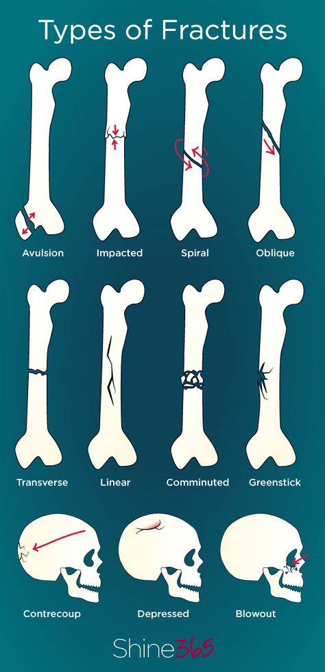 Understand 11 types of bone breaks from Shine365 & Marshfield Clinic Bone Healing Process, Radiology Anatomy, Anatomy Diagrams, Types Of Fractures, Student Quotes, Wardrobe Men, Types Of Bones, Nursing Gifts, Basic Anatomy