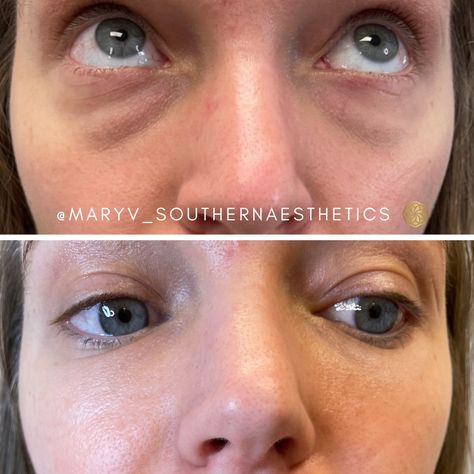 tear trough filler makes a H U G E difference! ⁠ ⁠ dm me today if you want to get rid of dark, hollow undereyes & look more refreshed 🥰 Tear Trough Filler, Tear Trough, H U, Dm Me, Nose Ring