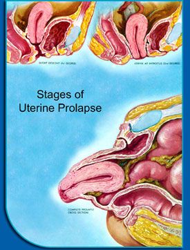 stages of uterine prolapse Uterine Polyps, Bladder Prolapse, Uterine Prolapse, Pelvic Health, Pelvic Organ Prolapse, Kegel Exercise, Reconstructive Surgery, Nerve Damage, After Surgery