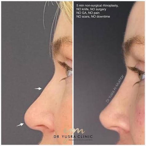 Dorsal Hump Rhinoplasty, Asian Nose Job, Nose Inspiration, Nose Job Inspiration, Low Nose Bridge, Nose Job Front View, Nose Fillers, Nose Types, Nose Reshaping