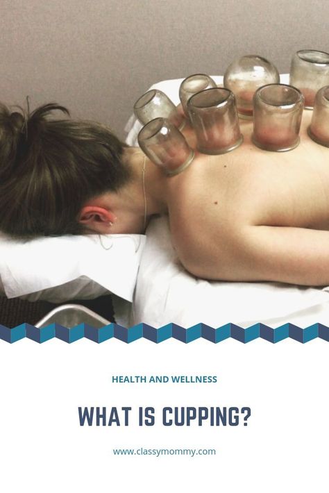 The health benefits of cupping and why you should try it. #health #wellness #cupping Heath And Wellness, Swim Team Mom, Wet Cupping, Hijama Cupping, Wellbeing Centre, Fire Cupping, Swimming World, Eastern Medicine, Cupping Therapy