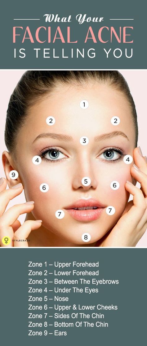 What Your Facial Acne Is Telling You #facial #facial #acne What Your Acne Is Telling You, Eyebrow Acne, Acne Between Eyebrows, Face Cleaner, Get Rid Of Pimples, Rid Of Pimples, Acne Overnight, Pimples Overnight, Acne Help