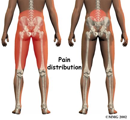 Arthropathy of Lumbar Facet Joint | Lumbar Facet Joint Arthritis ....I have been diagnosed with this after x-rays were read ...April 2014 LGMD...Dawn<3~ Spinal Degeneration, Chronic Back Pain, Middle Back Pain, Tight Hip Flexors, Knee Exercises, Knee Pain Relief, Gluten Sensitivity, Joints Pain Relief, Low Back Pain