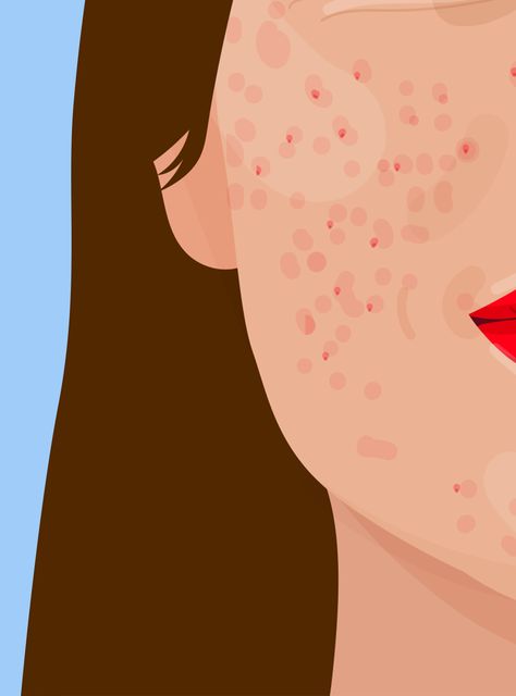 Pimples Under The Skin, Body Positivity Art, How To Get Rid Of Pimples, Beauty Posters, Illustration Art Girl, 수채화 그림, Beauty Illustration, Feminist Art, Art And Illustration