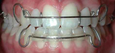 .
#healthyteethtips #dentalhealthcare Hawley Retainer, Braces Retainer, Retainer Teeth, After Braces, Clear Retainers, Teeth Aesthetic, Cute Braces Colors, Esthetic Dentistry, Holistic Dentistry