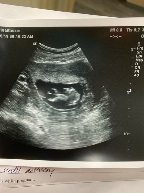 1st ultrasound of baby girl! 3 Month Ultrasound Pictures, Ultrasound Pictures 1 Month, Ultrasound Pictures 2023, Fake Ultrasound Pictures 4 Weeks, First Ultrasound Picture Ideas, Fake Ultrasound Pictures 2023, 3 Month Ultrasound, Fake Ultrasound Pictures, 5 Week Ultrasound Pictures