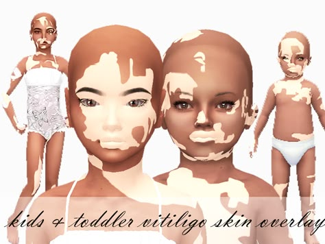 ForeverXXSims_Child&ToddlerVitligo_Merged Sims 4 Cc Vilitigo Skin Infant, Sims 4 Cc Toddler Skin Overlay, Sims 4 Cc Kids Body Presets, Sims 4 Vilitigo Cc, Sims 4 Cc Child Body Preset, Sims 4 Toddler Skin Details, Mom Sims 4 Cc, Sims 4 Cc Body Presets Kids, Sims 4 Cc Vilitigo Skin Details