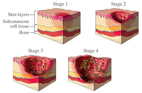 Mrsa Skin Infection in animals | Bed Sores - prevention and care Wound Care Nursing, Bed Sores, Pressure Ulcer, Nursing Tips, Natural Home Remedies, Natural Gifts, Natural Treatments, Home Health, Dermatology