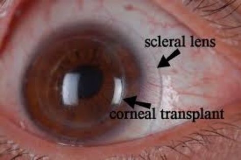 Blind Man Has First Artificial Transplant #News #WorldNews Corneal Transplant, Prosthetic Device, Optical Coherence Tomography, Eye Surgeon, Eye Contact Lenses, Crazy Eyes, Dry Eyes, Eye Health, Natural Cleaning Products