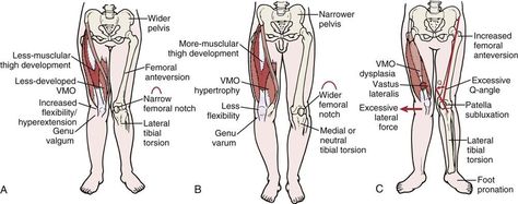 Genu valgum vs genu varus effect on patella - increased valgum actually causes lateral tracking of patella while increased varus causes medial tracking of patella Genu Valgum, Genu Varum, Bow Legged Correction, Physical Therapist Assistant, Bow Legged, Reflexology Massage, Athletic Training, Massage Techniques, Reflexology