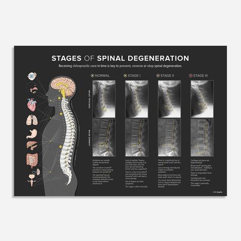 Spinal Degeneration, Spinal Health, Autonomic Nervous System, Chiropractic Care, Chiropractic, X Ray, Nervous System, In Time