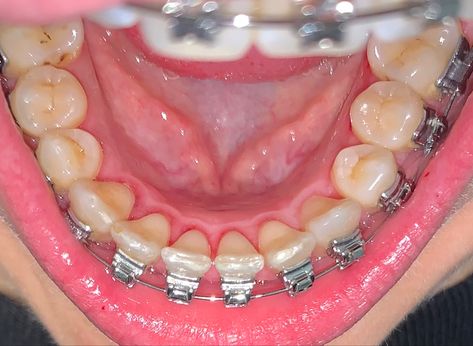 Adult Braces, Female Dentist, Dental Braces, Perfect Teeth, 8 Months, Braces, Aesthetic Food, Collage, Pins