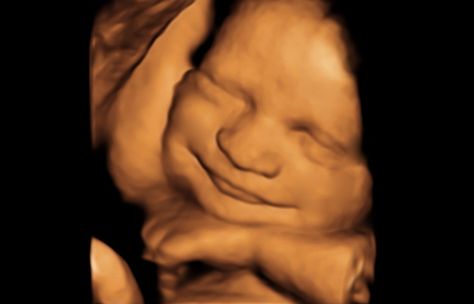 Sweet Dreams! 3d Ultrasound, 4d Ultrasound, Baby Ultrasound, Ultrasound Pictures, Baby Images, Precious Memories, Ultrasound, Sweet Dreams, Gender Reveal